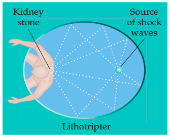 [b][size=150]Lithotripters are used for pulverizing kidney stones non-evasively using shock waves. [/size][/b]